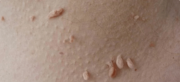A HPV átvitelének módszere