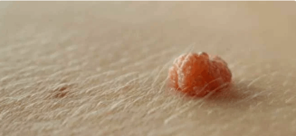 Papilloma vírus