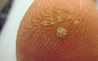 Miért jelennek meg a talpi szemölcsök