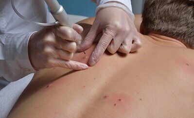 A papillómák eltávolításának módjai