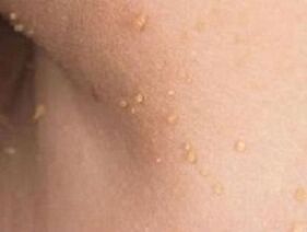 a papillómák megjelenésének okai a testen