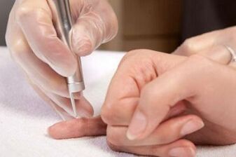 hogyan lehet megszabadulni a papillómáktól a testen